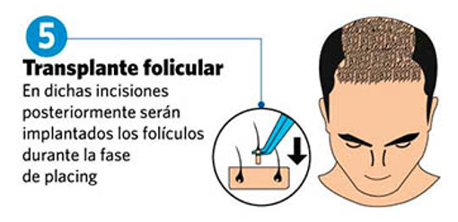 Paso a Paso Transplante Capilar 5