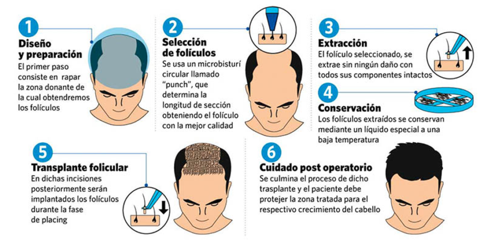 Paso a Paso Transplante Capilar completo