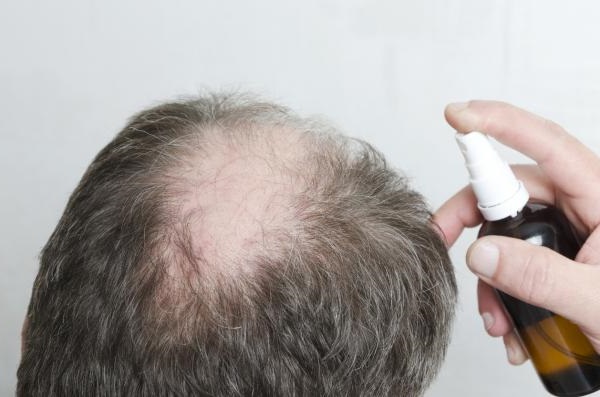 Cómo usar Minoxidil