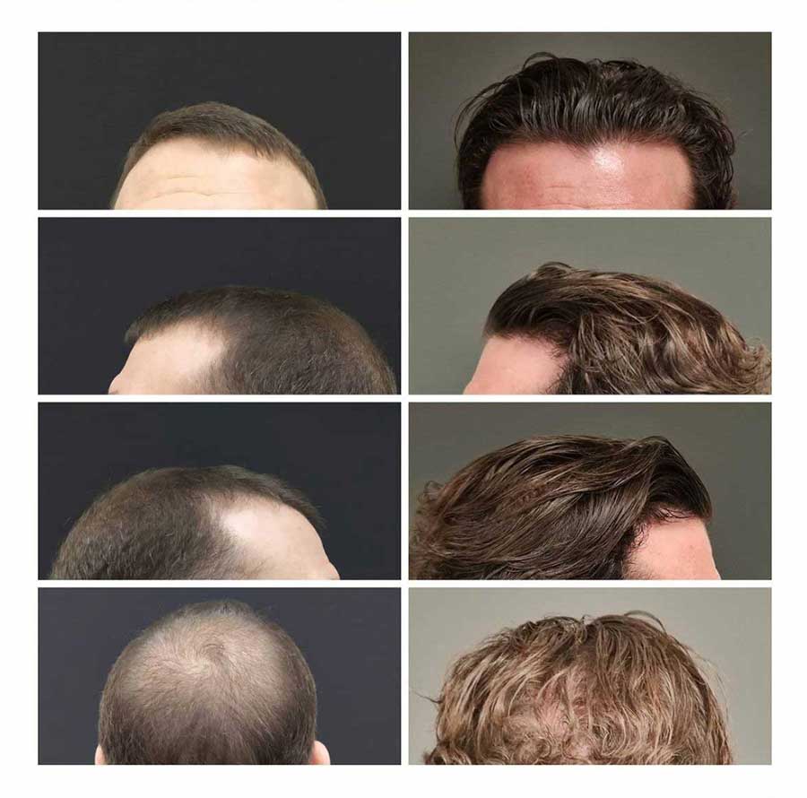 Tratamientos Para Después De Un Trasplante Capilar - Instituto Del Pelo