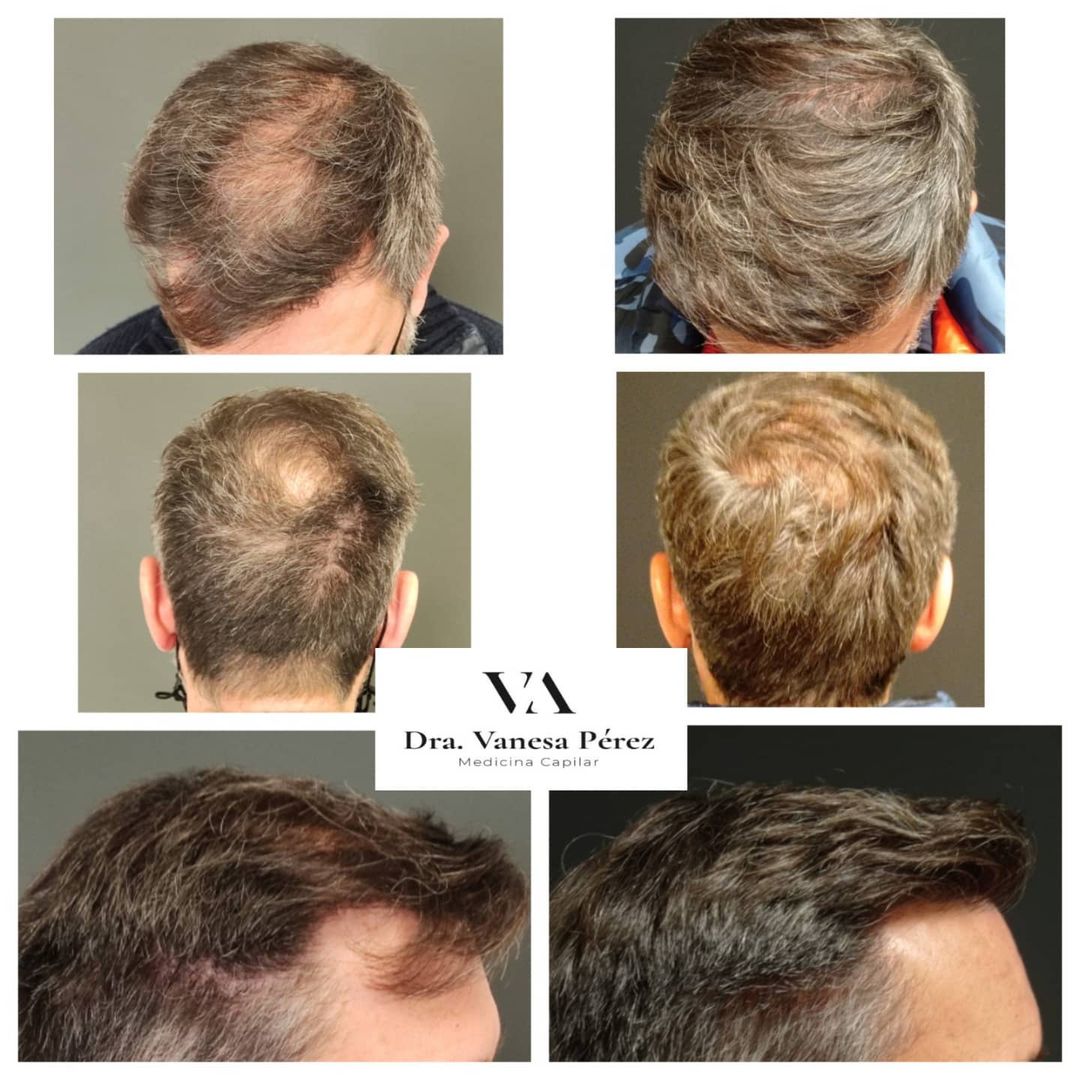Dutasteride alopecia shop
