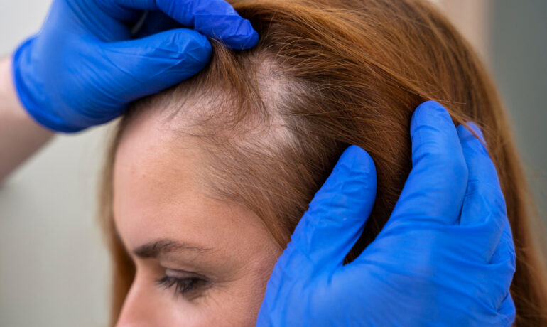 tipos de alopecia